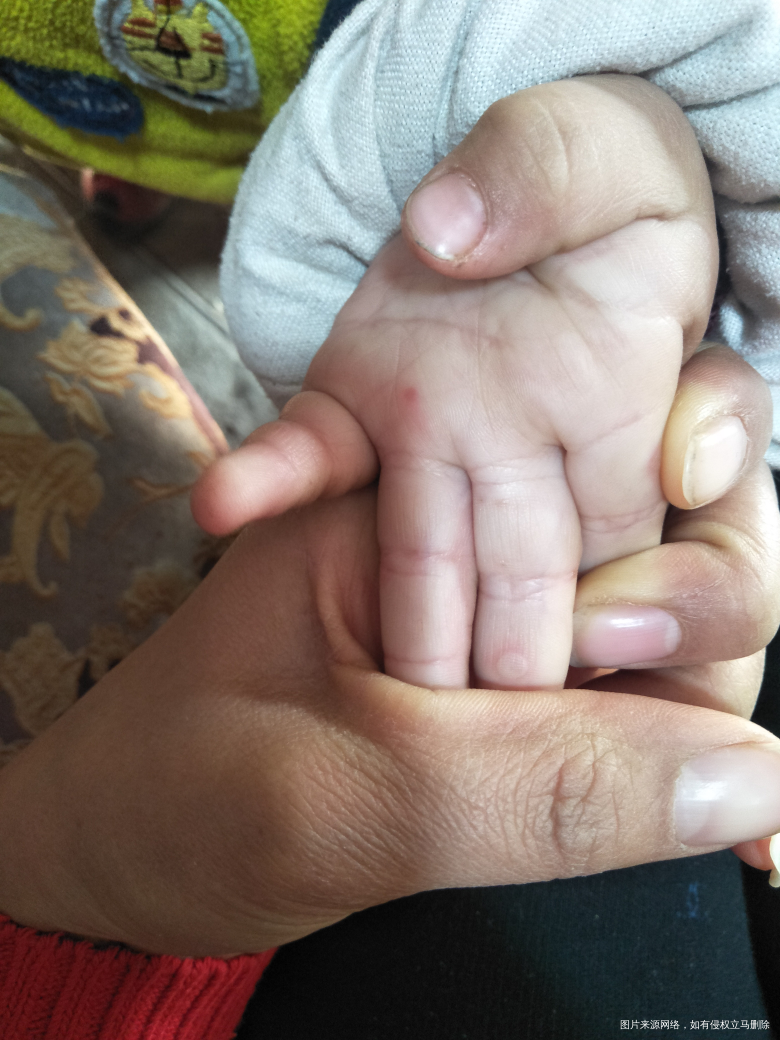 医生快点帮我看看宝宝的手,有小水泡