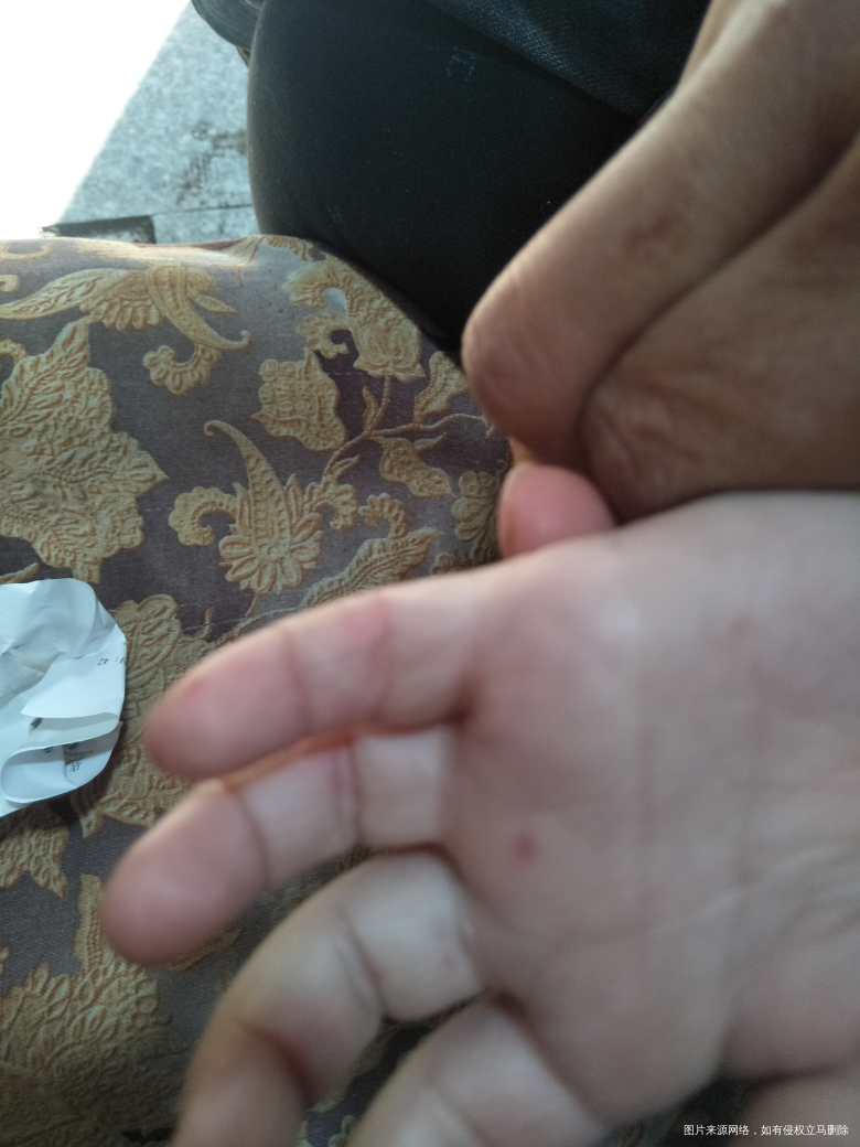 医生快点帮我看看宝宝的手,有小水泡
