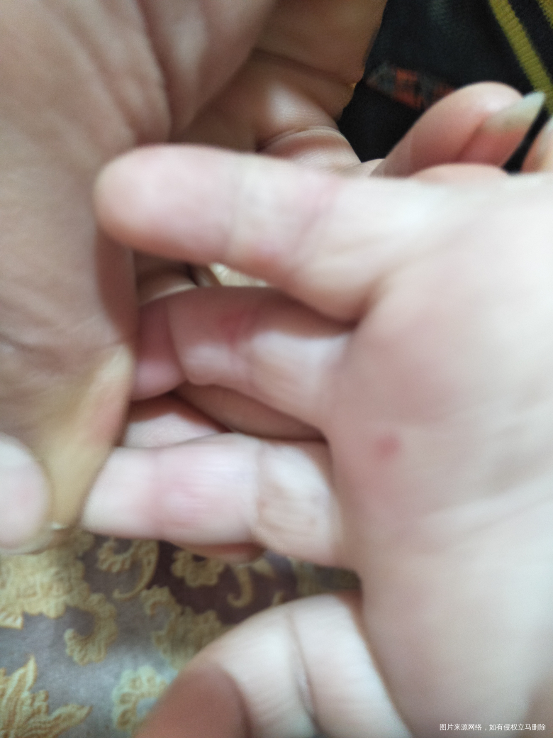 医生快点帮我看看宝宝的手,有小水泡