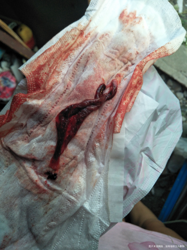 姐妹们帮看看这个是啥,月经排出来的,好大一个东西