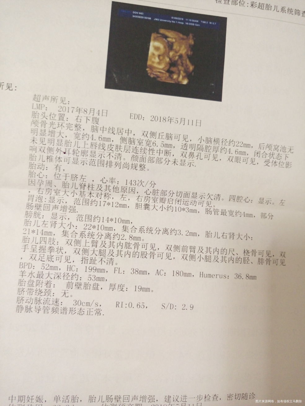 有没有姐妹知道胎儿肠管回声增强,双肾分离是什么情况的