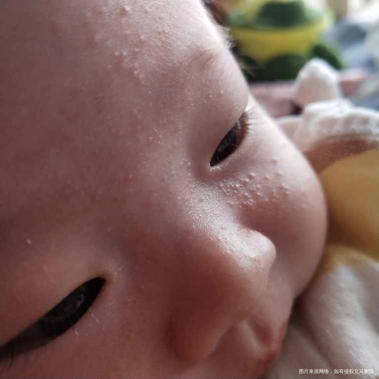 宝宝2个月了   脸上出了好多痘痘  这种是湿疹吗