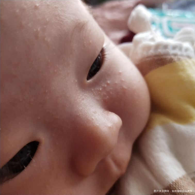 宝宝2个月了   脸上出了好多痘痘  这种是湿疹吗
