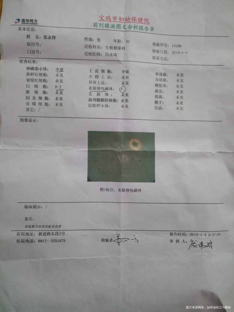 精子畸形率97%,前列腺液检卵磷脂少量,
