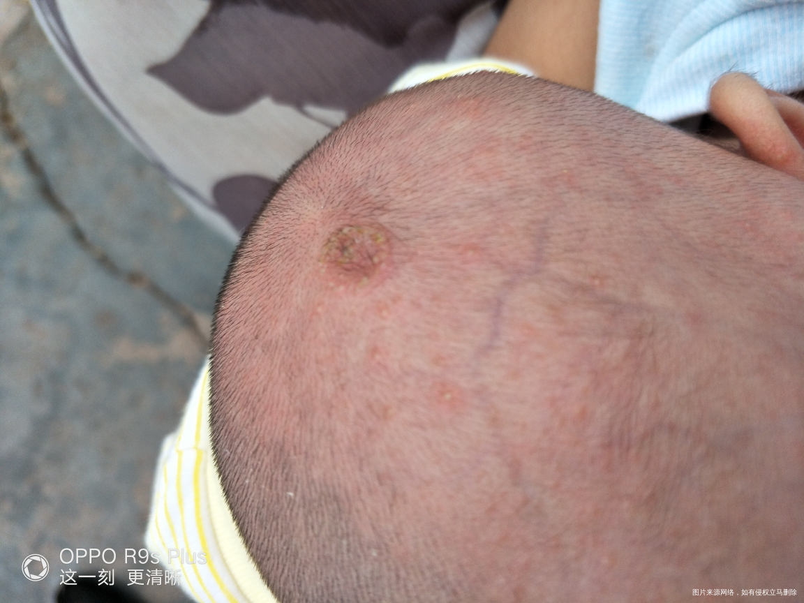 我宝宝四十二头上不知道长了什么