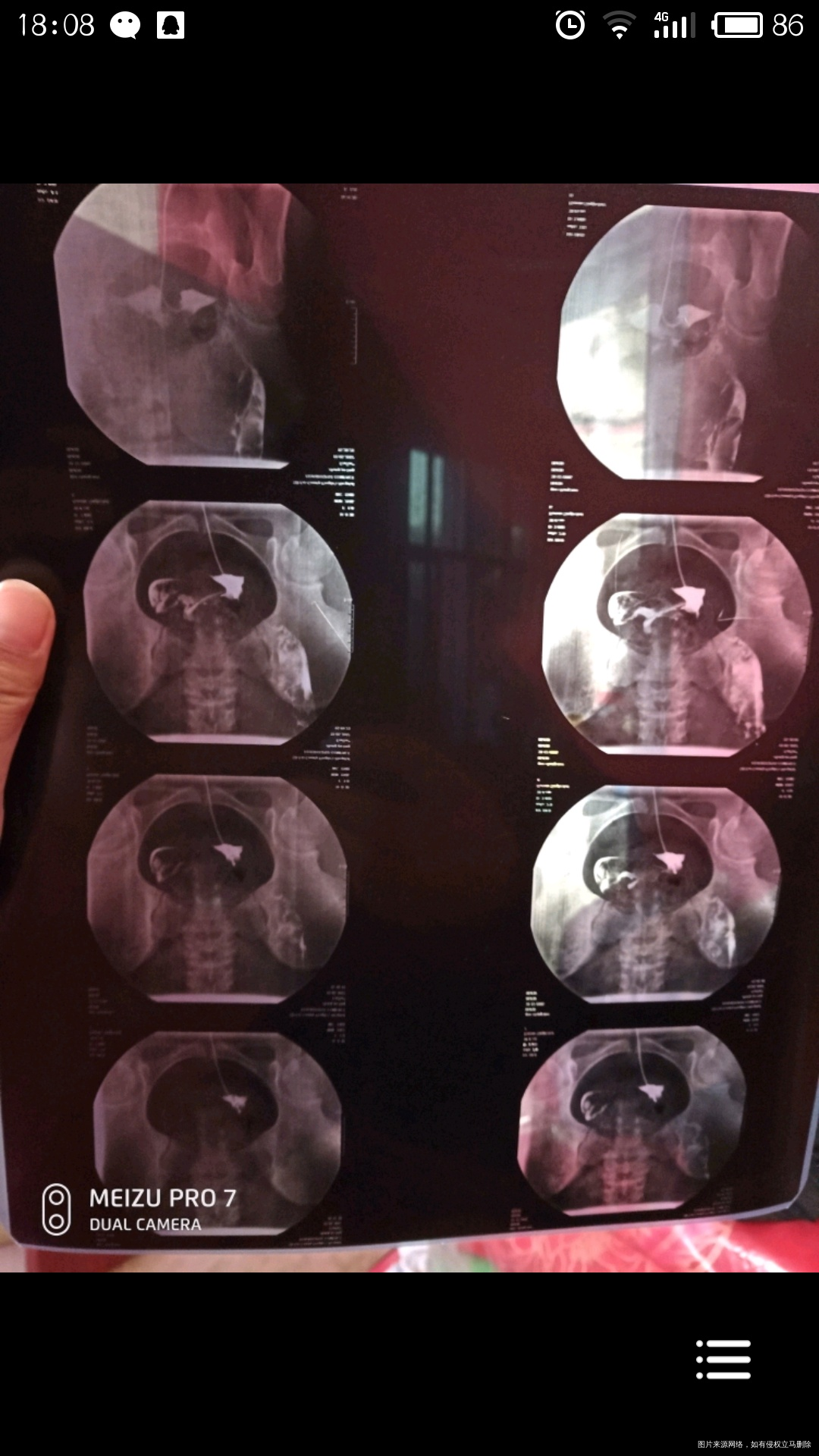 做的输卵管造影,请问有什么问题嘛?可以要宝宝了嘛?