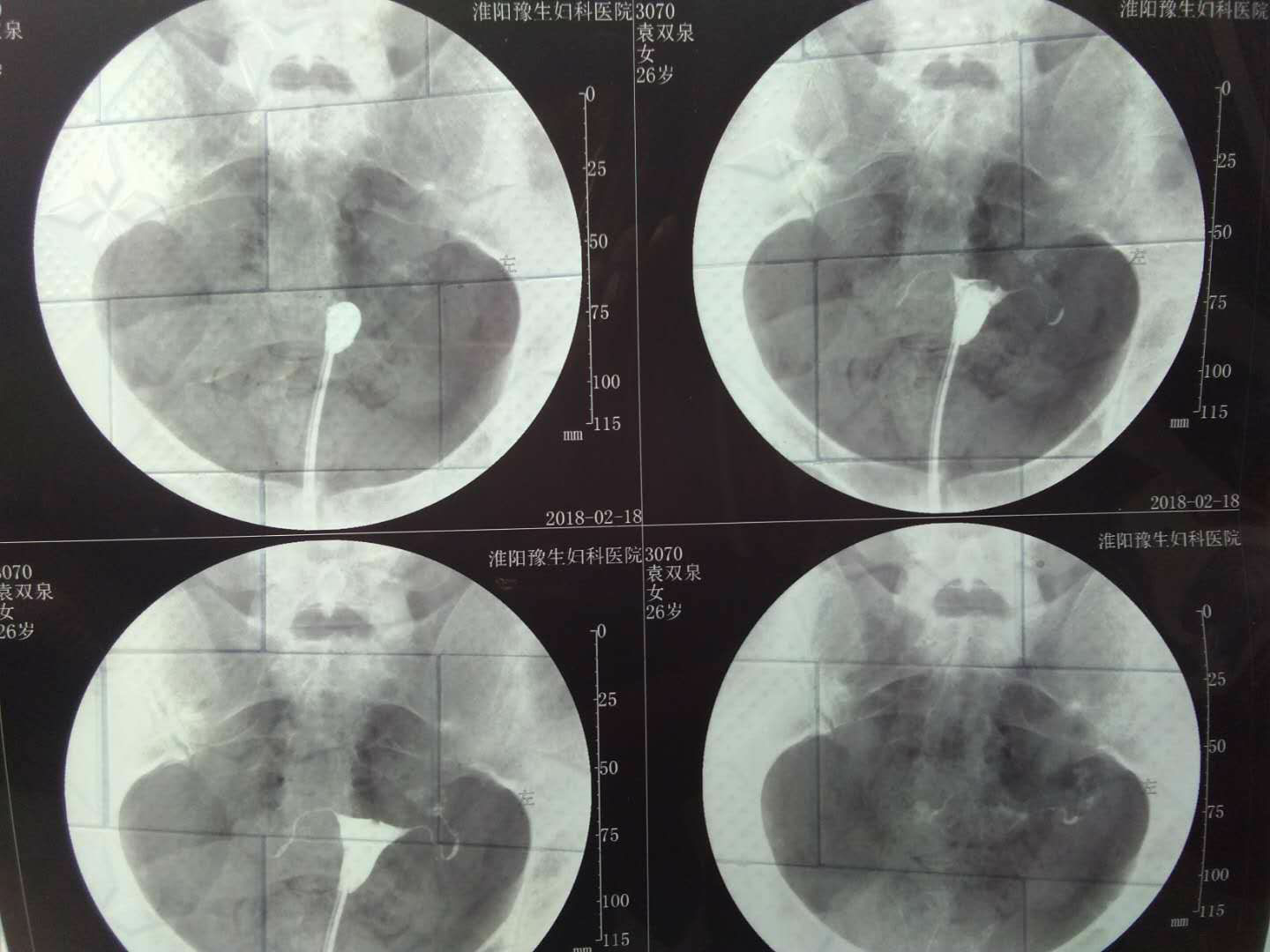 我以前得过肺结核，现在输卵管堵塞黏连还有