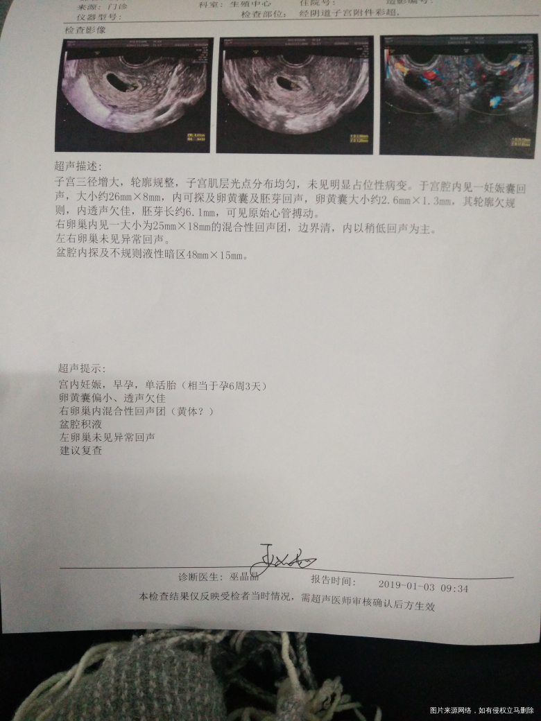 麻烦医生帮我看看什么时候做NT比较好?