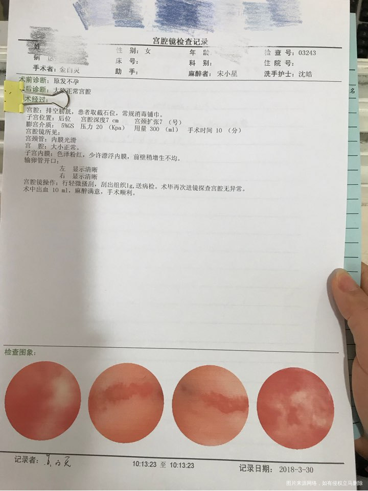 麻烦医生帮忙看看宫腔镜检查报告