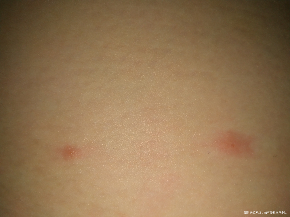 腿上长了四五个疙瘩,痒,有一个礼拜了