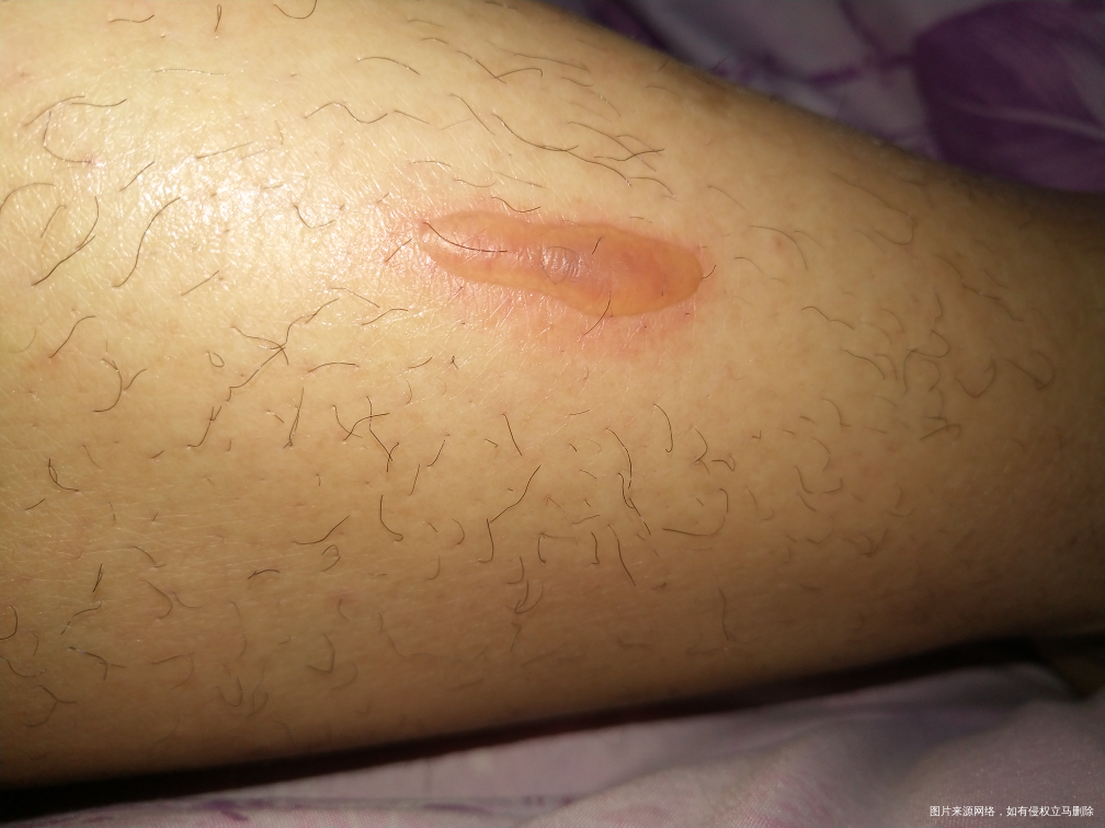 老公腿上长了一个水泡,摸着疼,