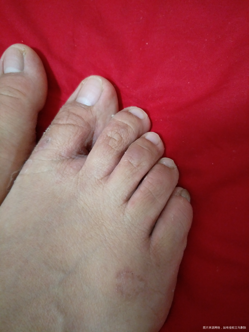 哺乳期脚气怎么样😭😭😭😭