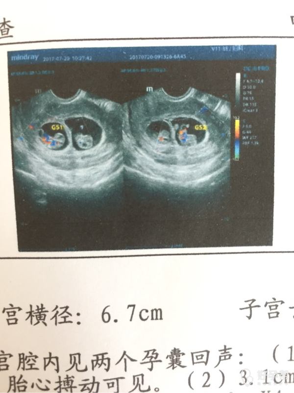 孕期60天,b超显示宝宝很好,之前查有液性暗区,医生让静养,吃保胎药