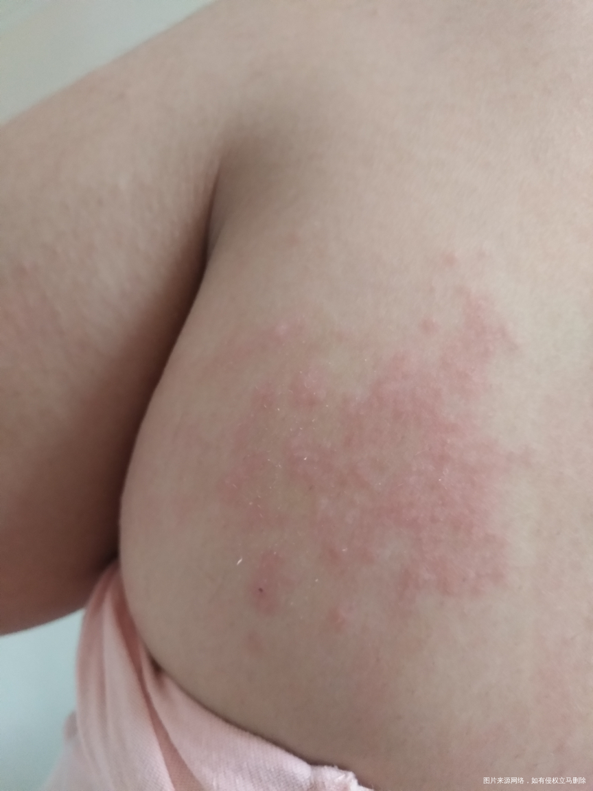 生完孩子起了些这个,怎么办??急急急