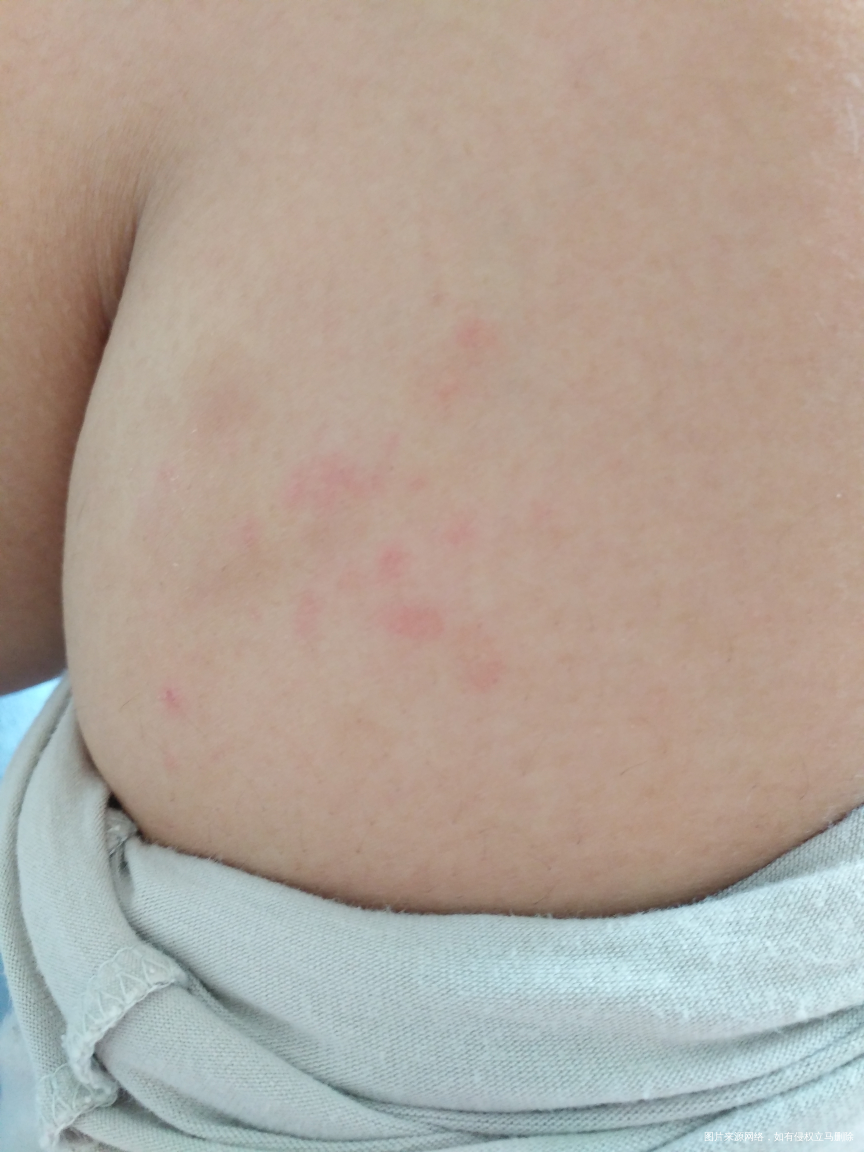 生完孩子起了些这个,怎么办??急急急