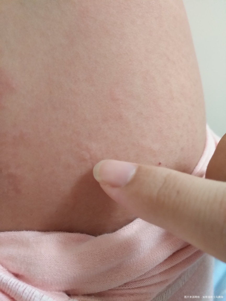 生完孩子起了些这个,怎么办??急急急