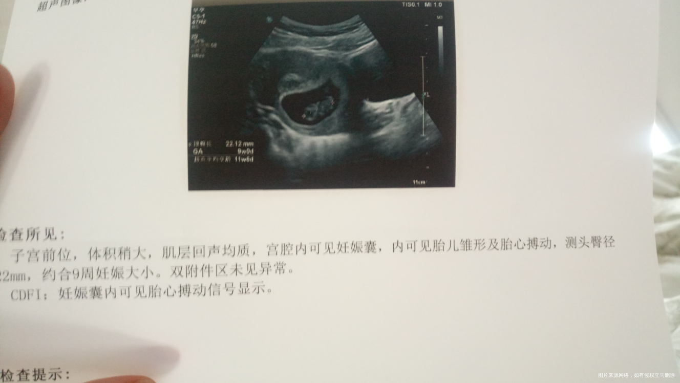 怀孕八周+4阴道流血,请医生看一下