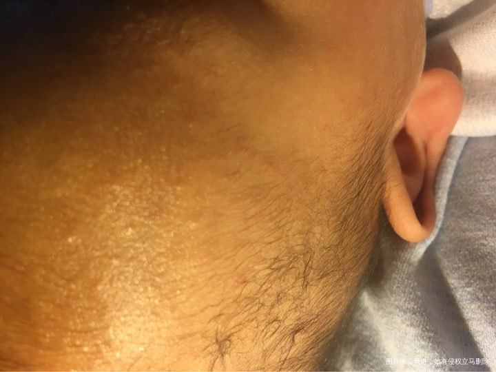 医生帮忙看看头上的是什么