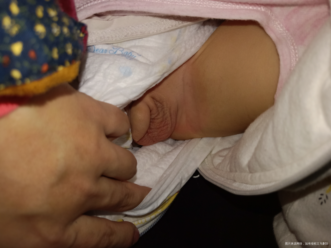 急急急!宝宝小鸡鸡痒的厉害