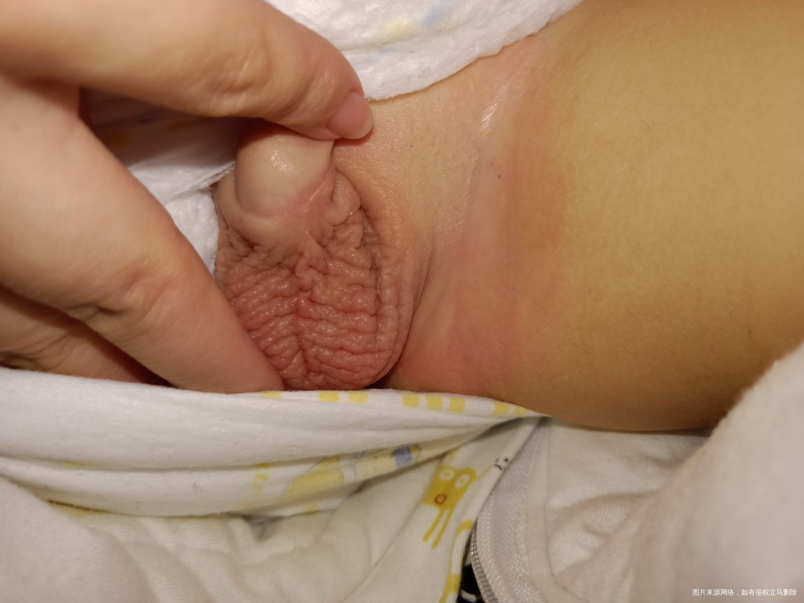 急急急!宝宝小鸡鸡痒的厉害