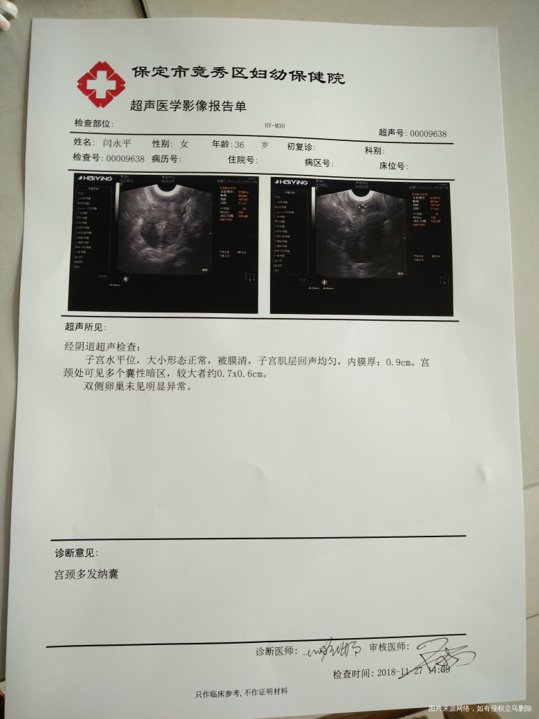 请问有纳囊影响做试管吗