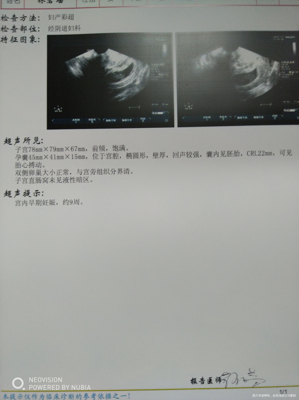 
今天去做b超了,宝妈们帮我看看数据咯