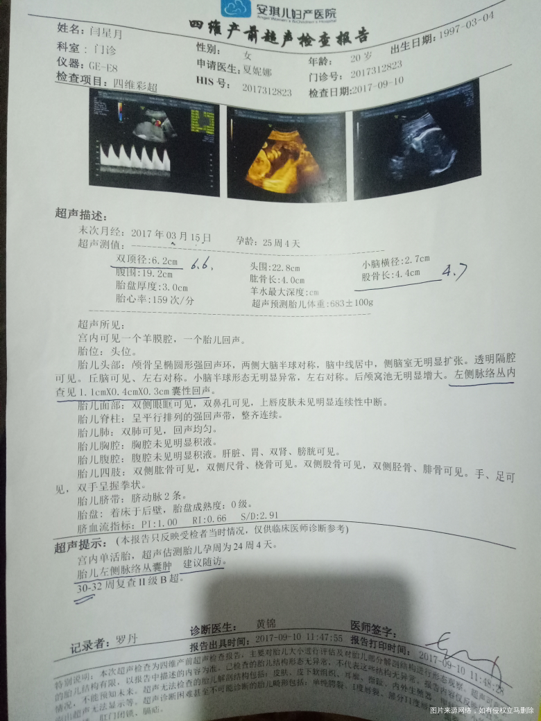 四维彩超结果,脉络丛囊肿什么意思啊?求医生帮忙看看!