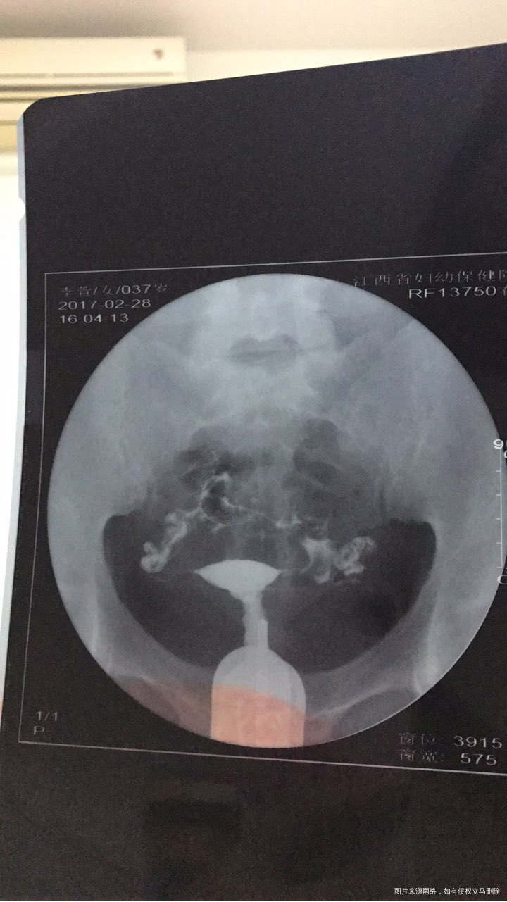 输卵管通而不畅,中药灌肠过敏