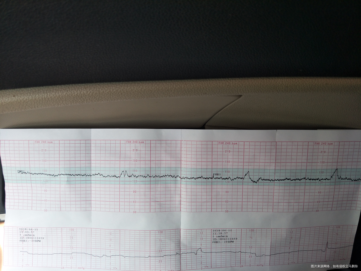 医生帮忙看下胎心监护过了吗?有宫缩吗?