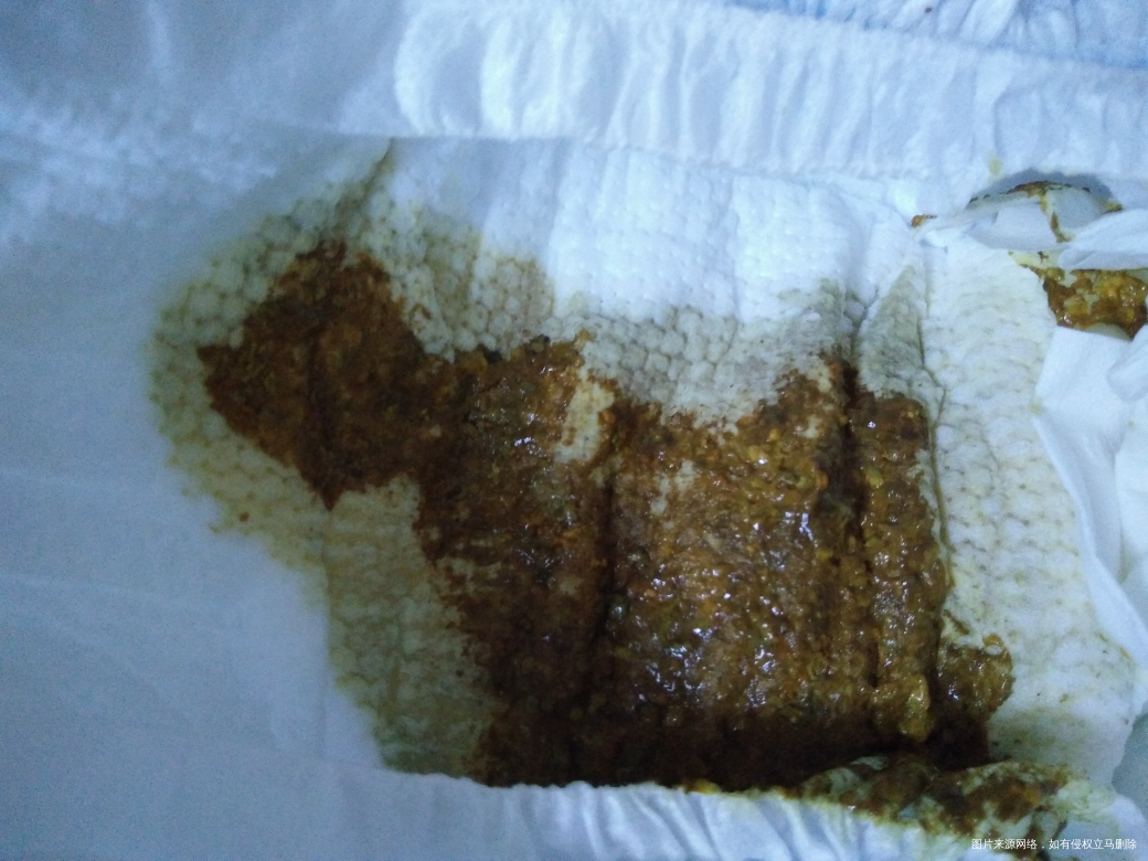 宝宝黄疸值11,吃了茵栀黄