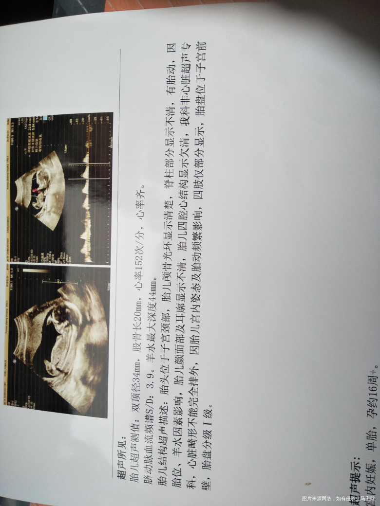 等待唐筛结果中,这是之前的报告