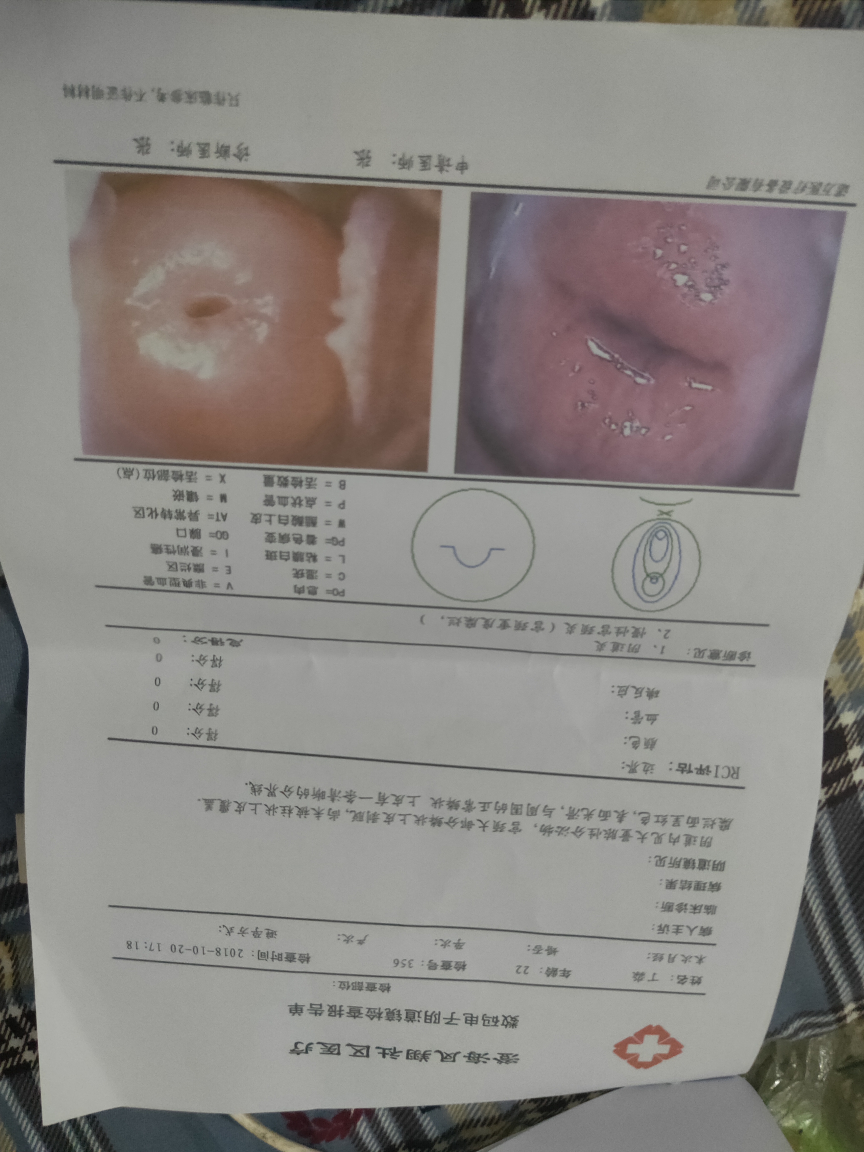 宫颈糜烂重度，盆腔积液约16mm还有阴道炎