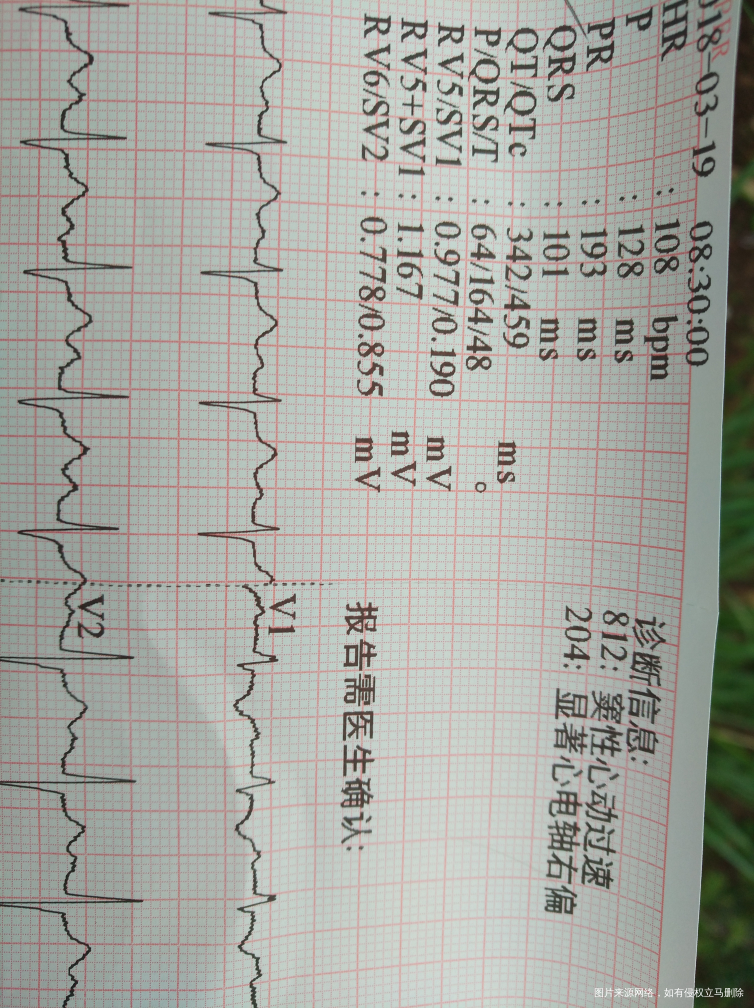 这个心电图有什么问题吗