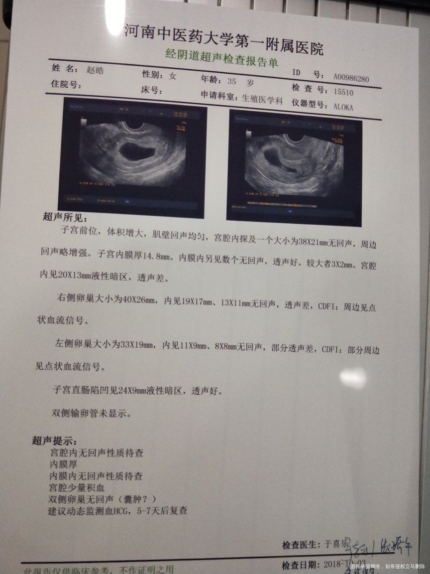 空囊怎么形成的,是精子质量不好吗?