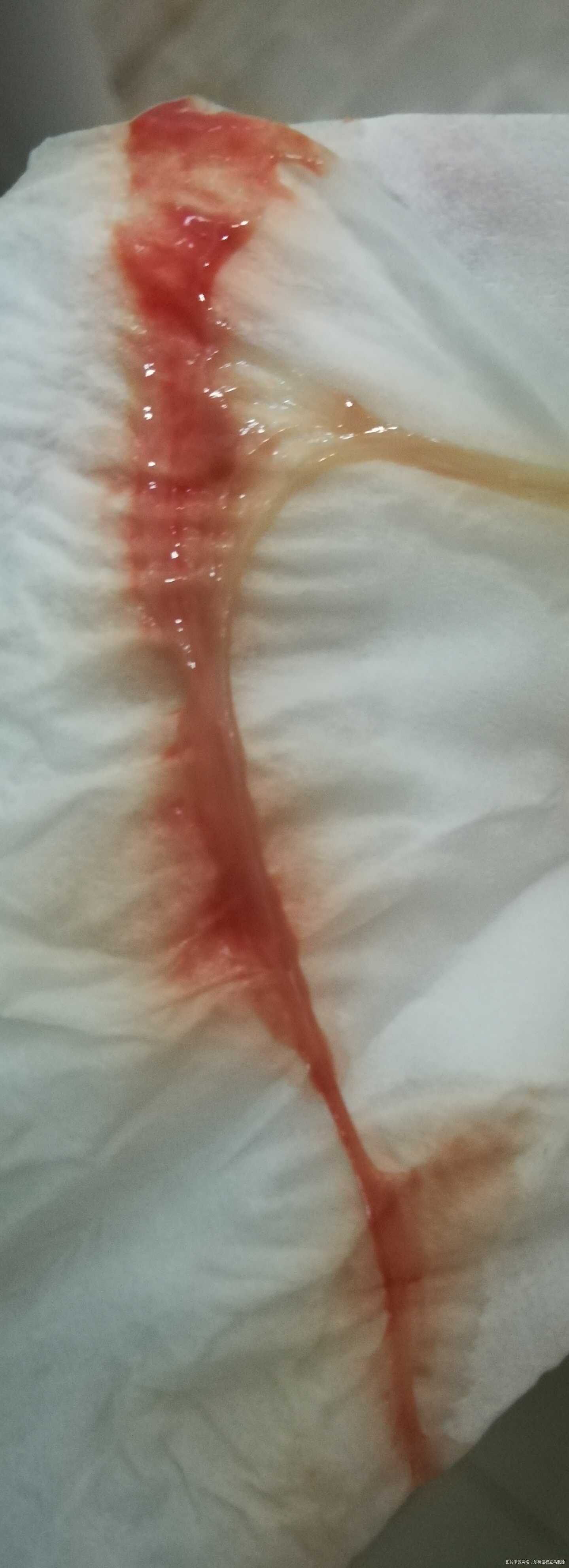 孕六周+3,出现一大条红色分泌物