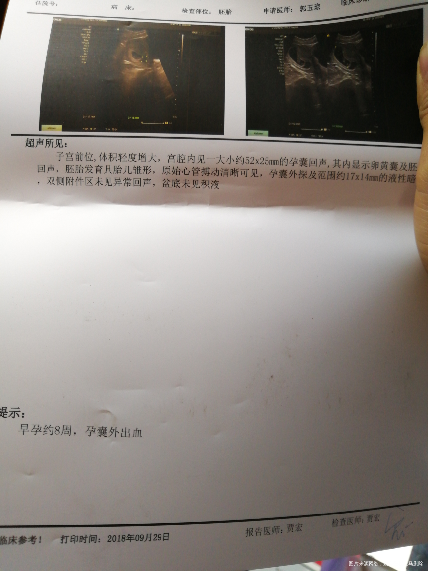 孕8周,医生帮我看看,谢谢谢谢