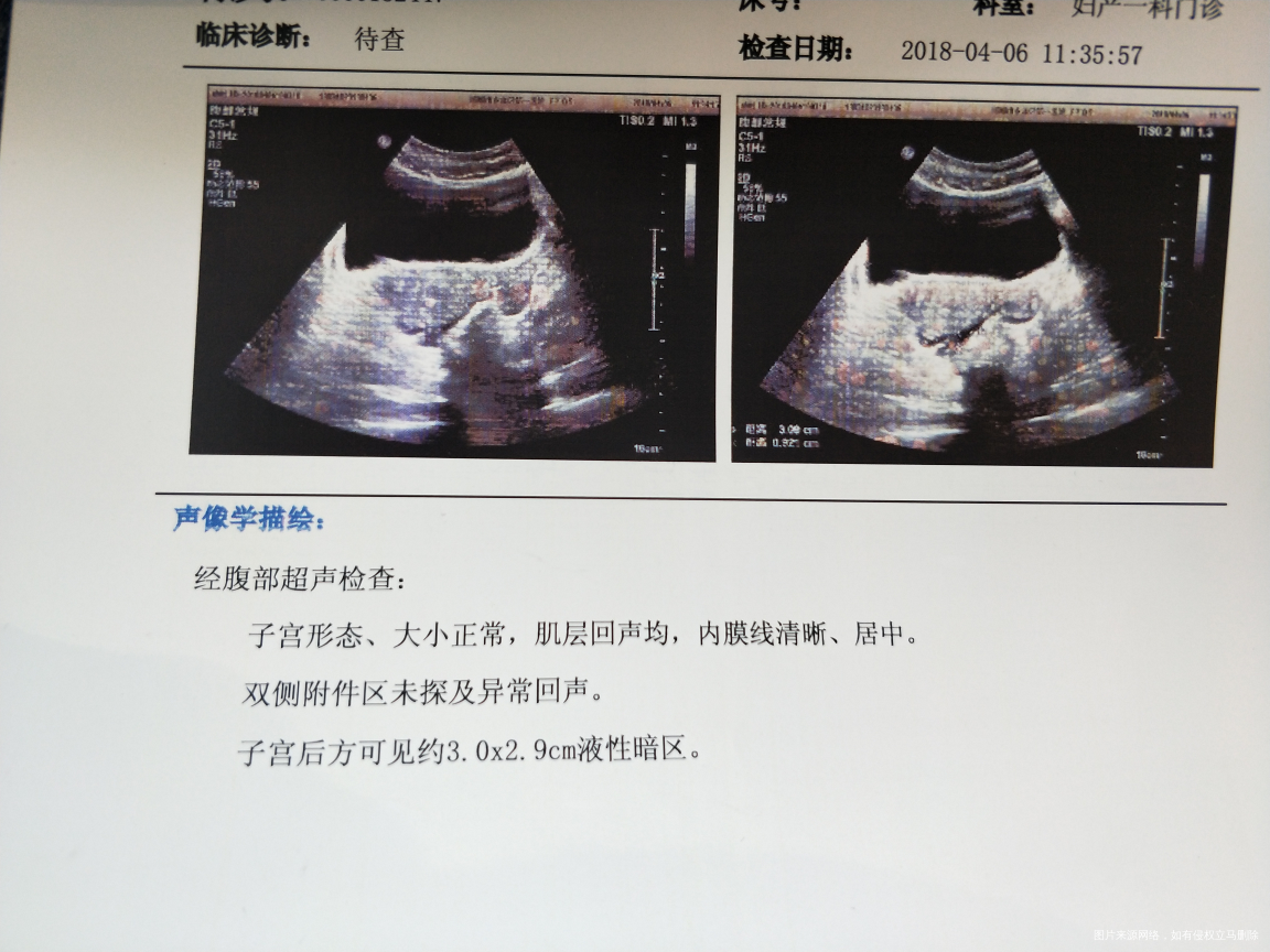 
血检测出怀孕 b超还显不出来但是有点盆腔积液 对宝宝有影响吗…