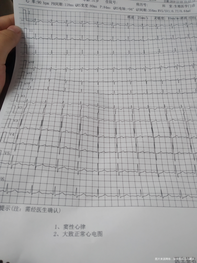 刚做的心电图不知道正常吗?