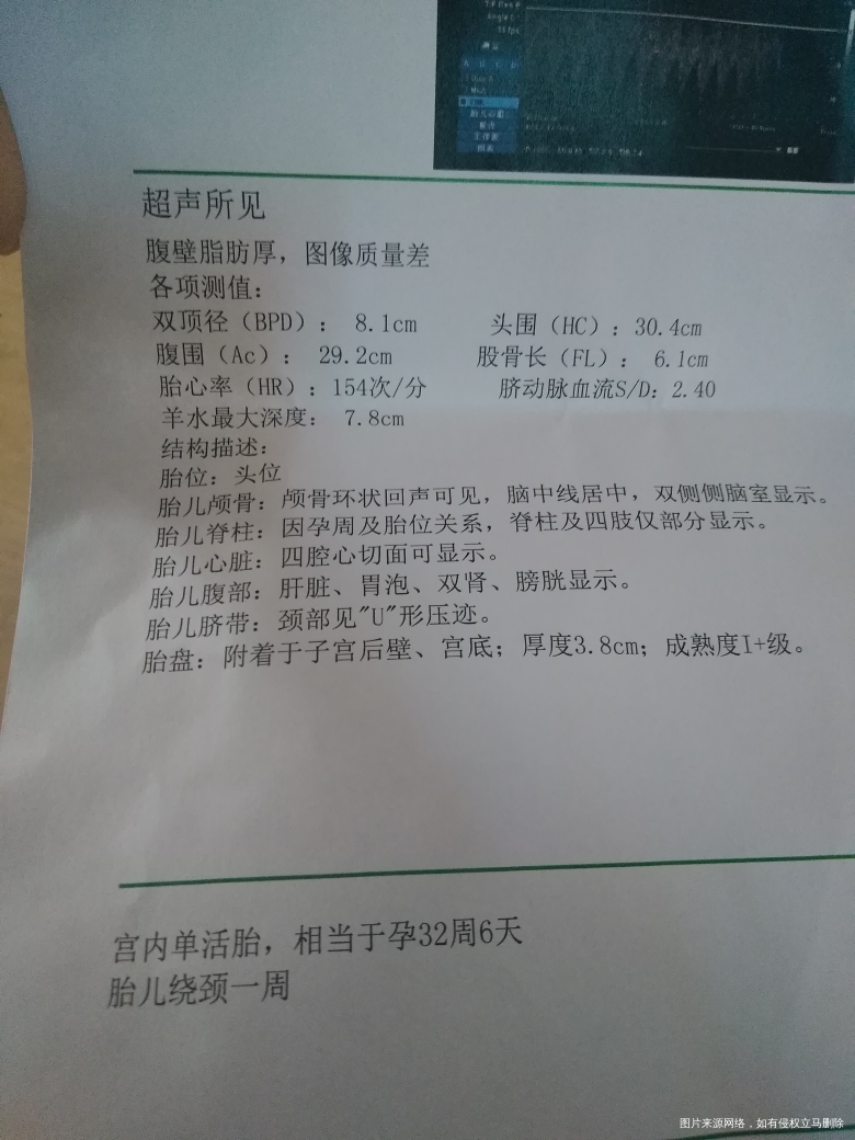 请医生帮我看一下脐带绕颈一周有事不