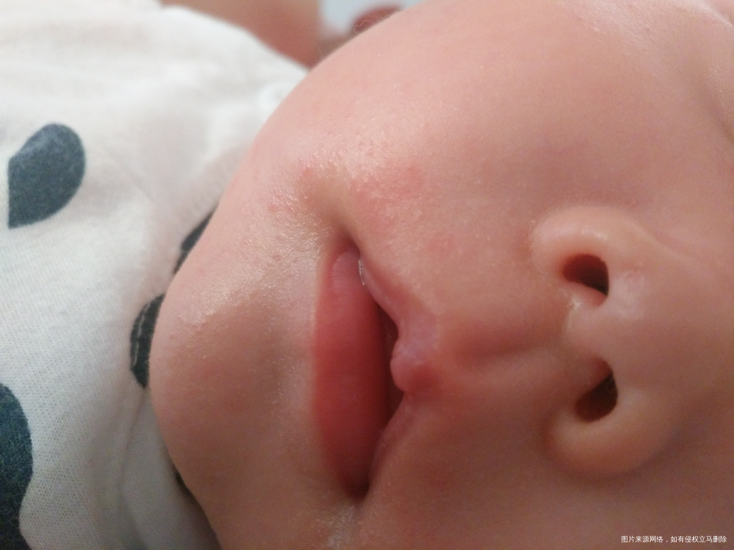 急!急!宝宝2个多月,嘴周围和耳朵后面起小疙瘩,
