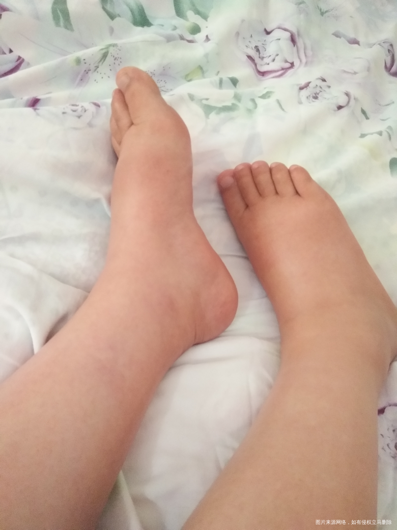 
脚肿了,最近翻身也好累