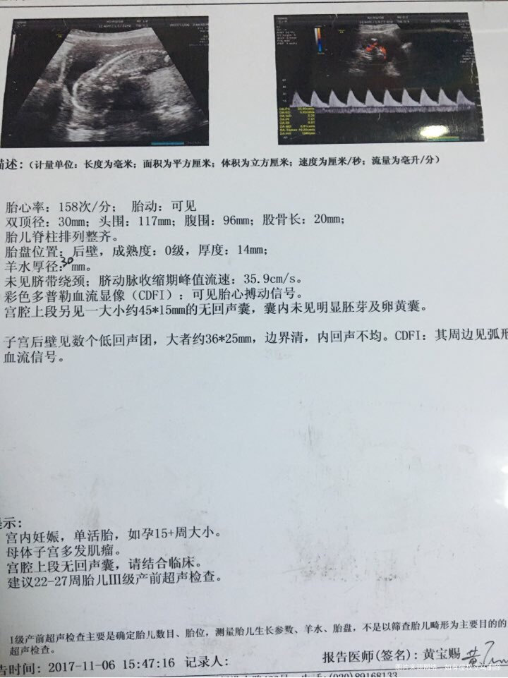 求助医生子宫肌瘤问题