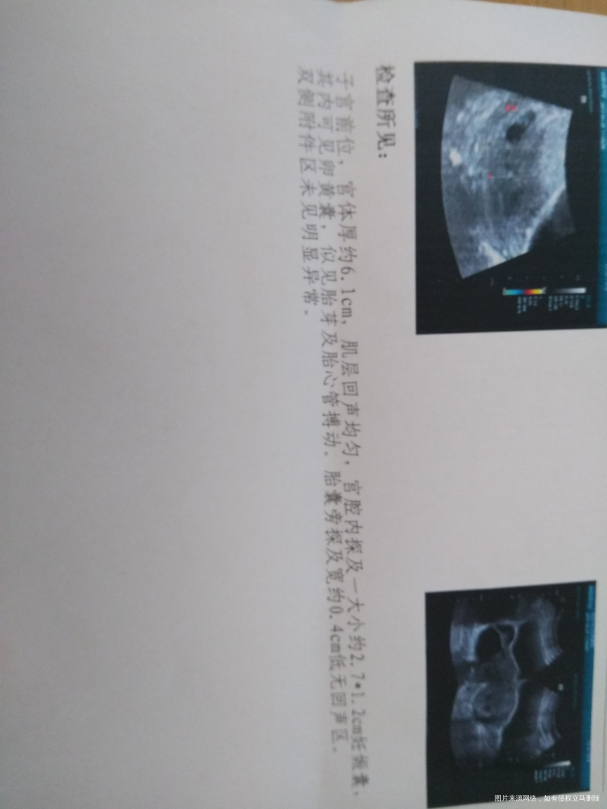 帮我看看这是多少天的孕囊