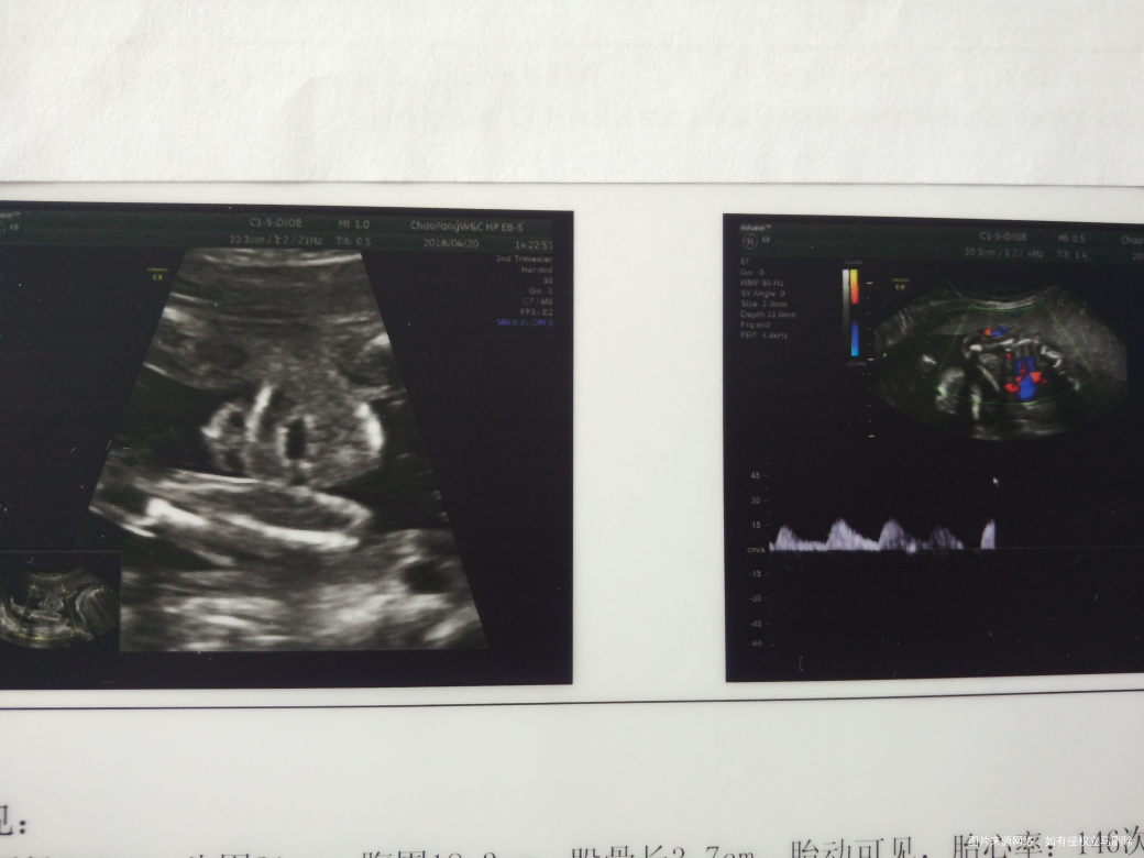 麻烦医生帮我看下排畸b超