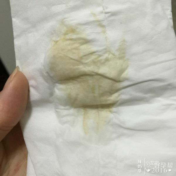 医生,我自从怀孕后白带有时候就像这个一样,怀孕初期检查过说我有阴道
