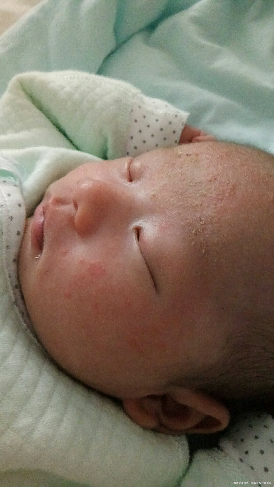 月里宝宝脸上不知道是长的湿疹还是什么
