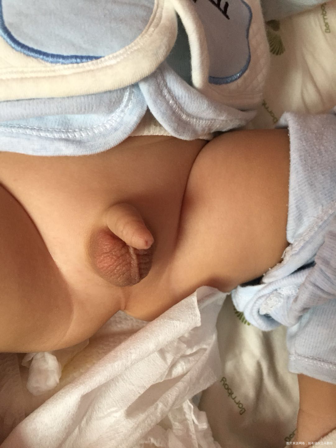 宝宝小鸡鸡一片片红的,怎么回事啊?急!