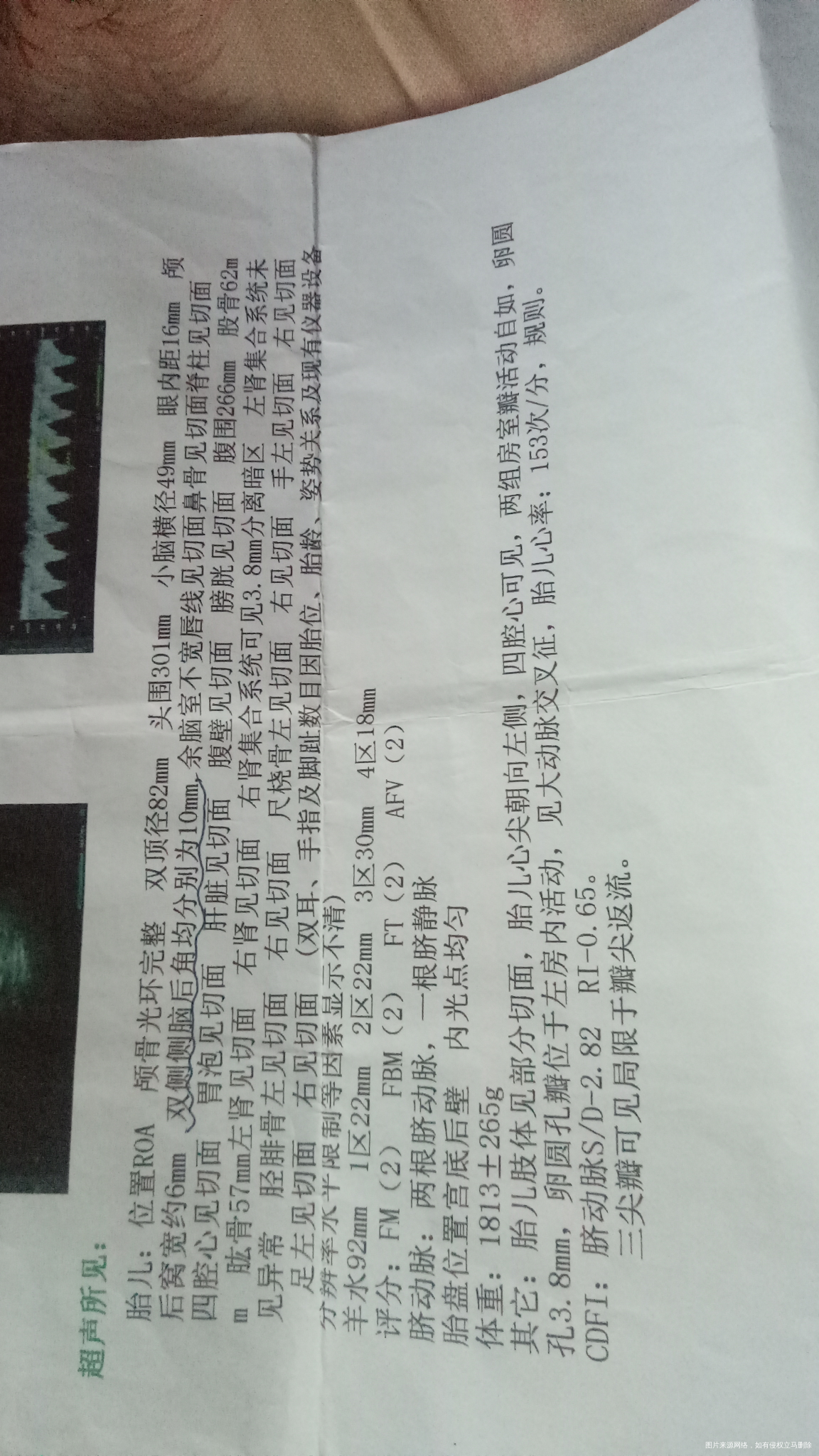 35周加4胎儿双侧侧脑后角均分别为10mm宝宝还能要吗?