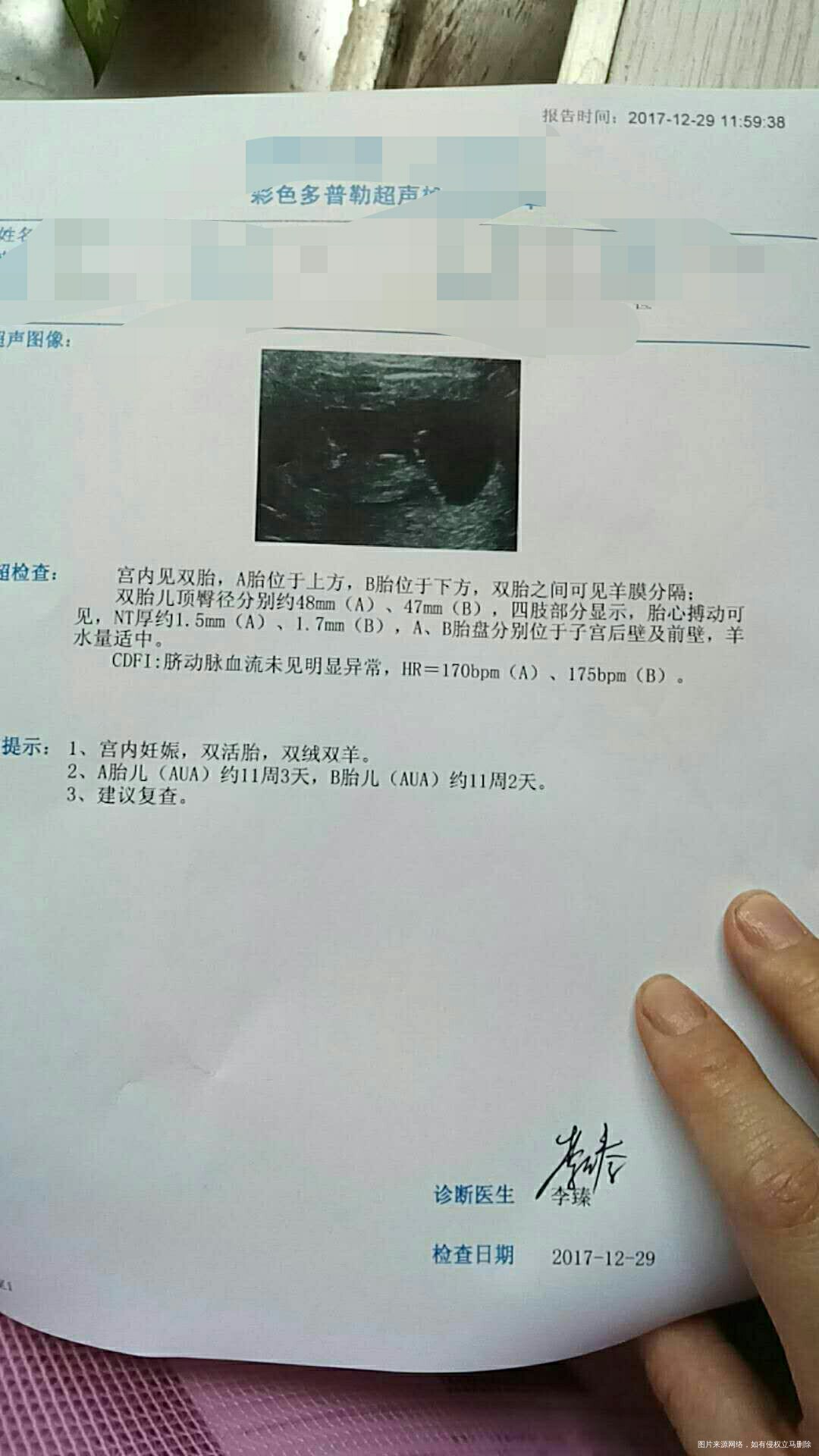 多囊怀孕双胎必须的做无创吗