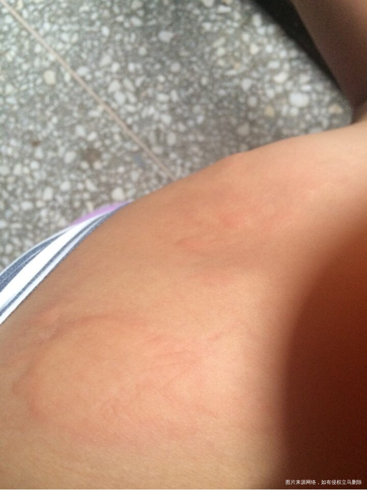 求助求助 孕六月起寻麻疹怎么办